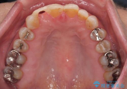 新幹線&飛行機で通院　最小限の通院で前歯のインプラント治療の治療前