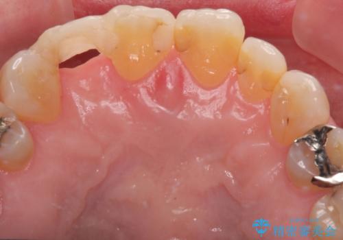 新幹線&飛行機で通院　最小限の通院で前歯のインプラント治療の治療前