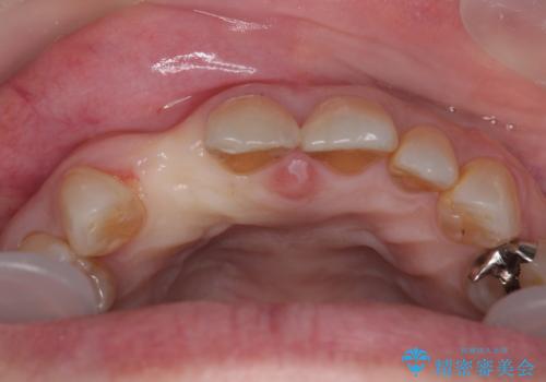 新幹線&飛行機で通院　最小限の通院で前歯のインプラント治療の治療前