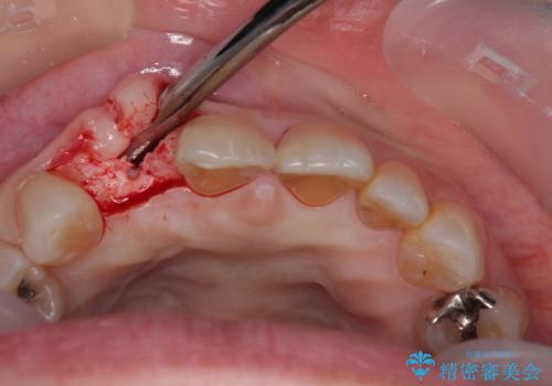 新幹線&飛行機で通院 最小限の通院で前歯のインプラント治療の治療中