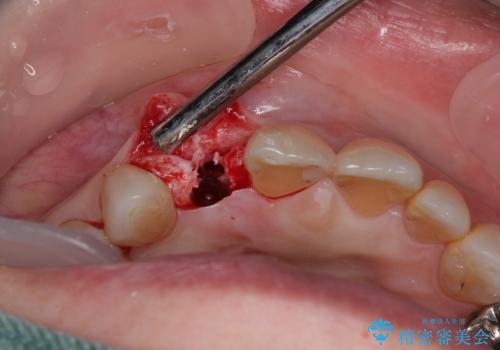 新幹線&飛行機で通院　最小限の通院で前歯のインプラント治療の治療後