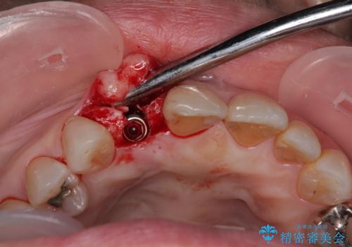 新幹線&飛行機で通院　最小限の通院で前歯のインプラント治療の治療前
