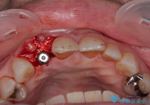 新幹線&飛行機で通院 最小限の通院で前歯のインプラント治療の治療中