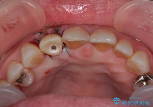 新幹線&飛行機で通院　最小限の通院で前歯のインプラント治療の治療中
