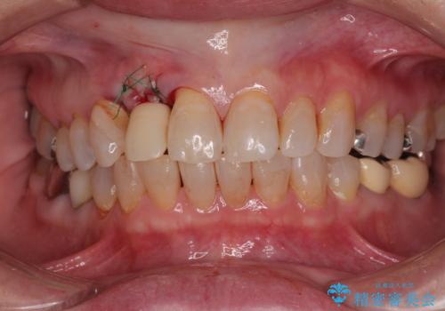 新幹線&飛行機で通院 最小限の通院で前歯のインプラント治療の治療中
