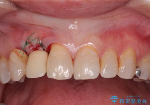 新幹線&飛行機で通院　最小限の通院で前歯のインプラント治療の治療中