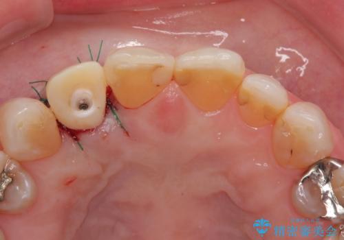 新幹線&飛行機で通院　最小限の通院で前歯のインプラント治療の治療中