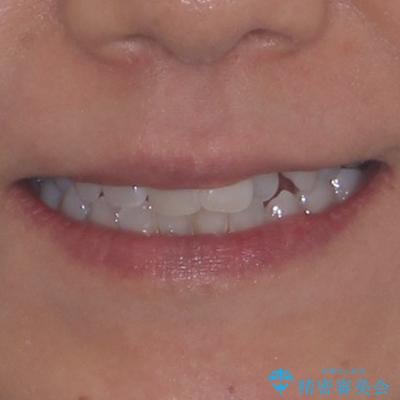クロスバイトを治したい インビザラインによる矯正治療の治療前(顔貌)