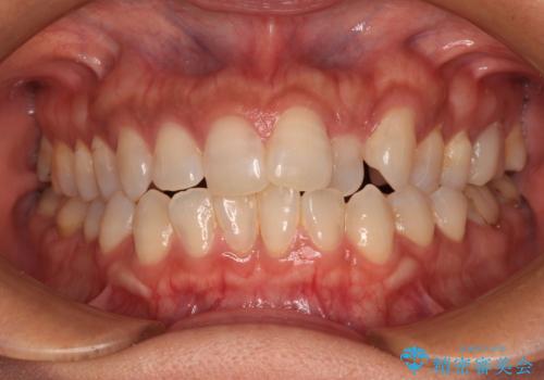 クロスバイトを治したい　インビザラインによる矯正治療の症例 治療前