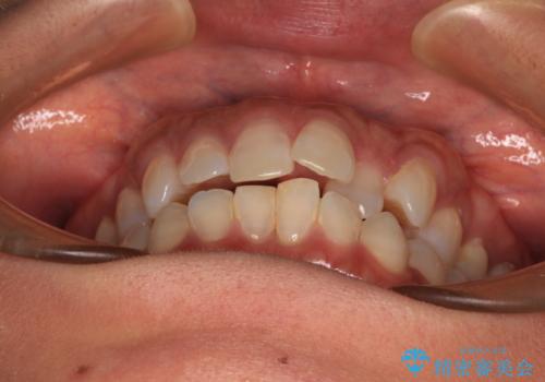 クロスバイトを治したい インビザラインによる矯正治療の治療前