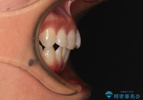 クロスバイトを治したい　インビザラインによる矯正治療の治療前