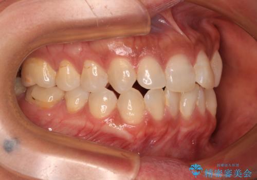 クロスバイトを治したい　インビザラインによる矯正治療の治療前