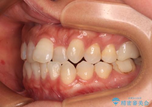 クロスバイトを治したい インビザラインによる矯正治療の治療前