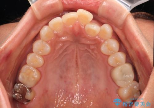 クロスバイトを治したい　インビザラインによる矯正治療の治療前