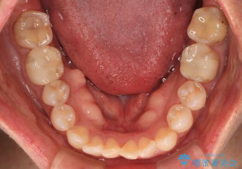 クロスバイトを治したい インビザラインによる矯正治療の治療前