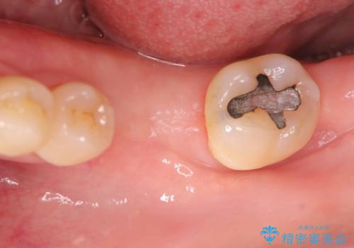 根尖性歯周炎|分岐部病変|パーフォレーション|インプラントで治療の治療中
