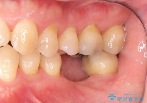 根尖性歯周炎|分岐部病変|パーフォレーション|インプラントで治療の治療中