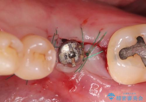 根尖性歯周炎|分岐部病変|パーフォレーション|インプラントで治療の治療中