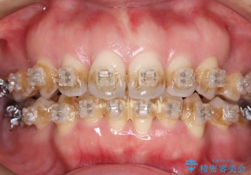 矯正中こそ大切にしたい、歯の透明感の症例 治療前