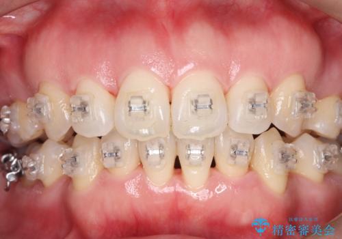 矯正中こそ大切にしたい、歯の透明感の治療後