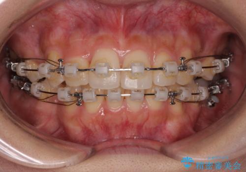 【モニター】閉じにくい前歯とクロスバイト ワイヤー装置での抜歯矯正の治療中