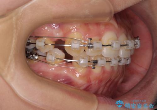 【モニター】閉じにくい前歯とクロスバイト ワイヤー装置での抜歯矯正の治療中