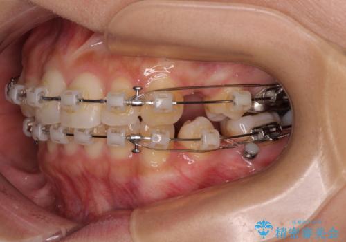 【モニター】閉じにくい前歯とクロスバイト ワイヤー装置での抜歯矯正の治療中