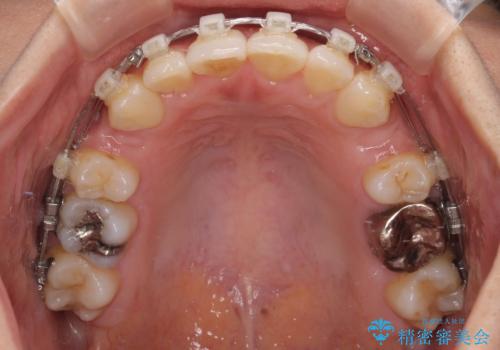 【モニター】閉じにくい前歯とクロスバイト ワイヤー装置での抜歯矯正の治療中