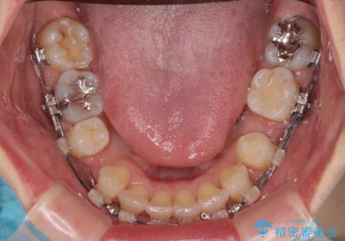 【モニター】閉じにくい前歯とクロスバイト ワイヤー装置での抜歯矯正の治療中