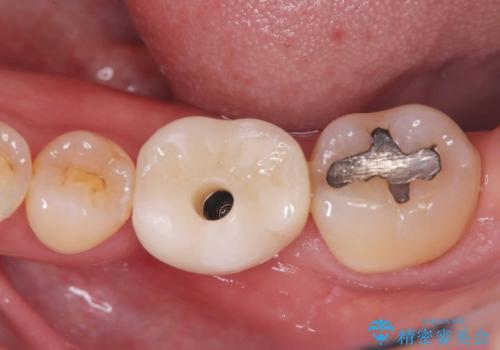 根尖性歯周炎|分岐部病変|パーフォレーション|インプラントで治療の治療中