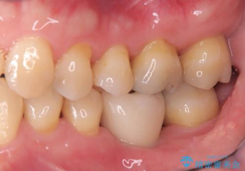 根尖性歯周炎|分岐部病変|パーフォレーション|インプラントで治療の治療後