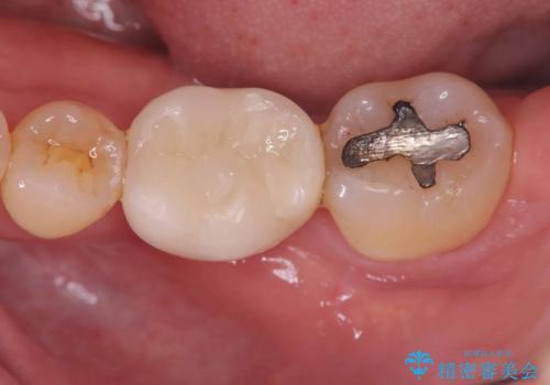 根尖性歯周炎|分岐部病変|パーフォレーション|インプラントで治療の症例 治療後