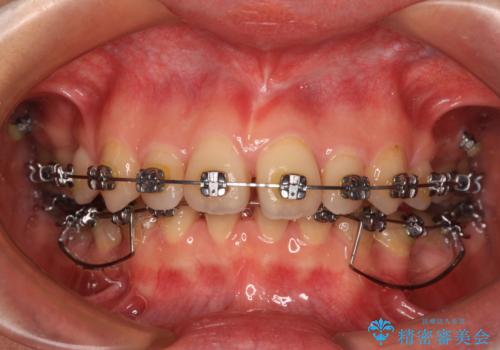 欠損や残存乳歯、深い咬み合わせ　ワイヤー矯正で咬合改善の治療中