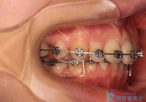 欠損や残存乳歯、深い咬み合わせ　ワイヤー矯正で咬合改善の治療中