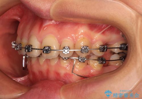 欠損や残存乳歯、深い咬み合わせ　ワイヤー矯正で咬合改善の治療中