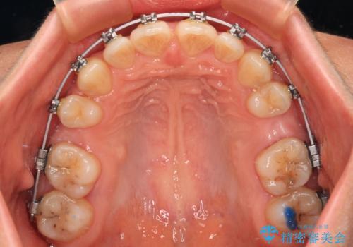 欠損や残存乳歯、深い咬み合わせ　ワイヤー矯正で咬合改善の治療中