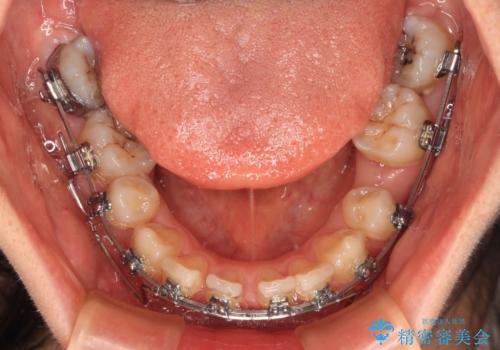 欠損や残存乳歯、深い咬み合わせ　ワイヤー矯正で咬合改善の治療中