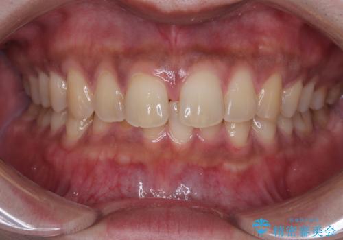 目立たない矯正で正中離開と下の前歯のデコボコを改善|インビザラインによる治療症例の症例 治療前