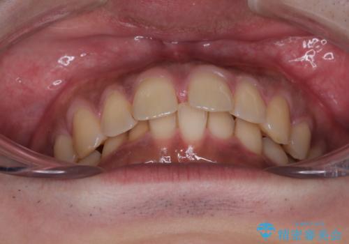 目立たない矯正で正中離開と下の前歯のデコボコを改善|インビザラインによる治療症例の治療前