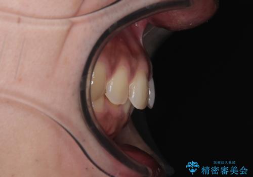 目立たない矯正で正中離開と下の前歯のデコボコを改善|インビザラインによる治療症例の治療前