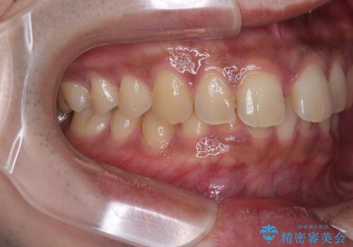 目立たない矯正で正中離開と下の前歯のデコボコを改善|インビザラインによる治療症例の治療前