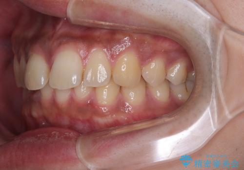 目立たない矯正で正中離開と下の前歯のデコボコを改善|インビザラインによる治療症例の治療前