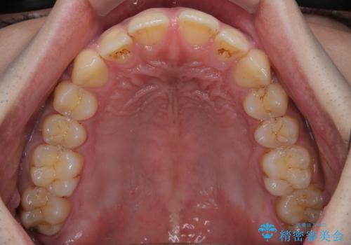 目立たない矯正で正中離開と下の前歯のデコボコを改善|インビザラインによる治療症例の治療前