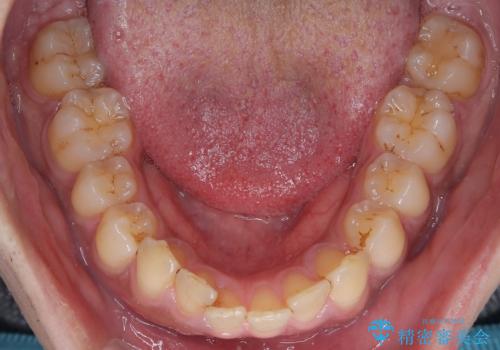 目立たない矯正で正中離開と下の前歯のデコボコを改善|インビザラインによる治療症例の治療前