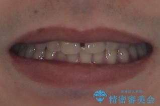 目立たない矯正で正中離開と下の前歯のデコボコを改善|インビザラインによる治療症例の治療前(顔貌)