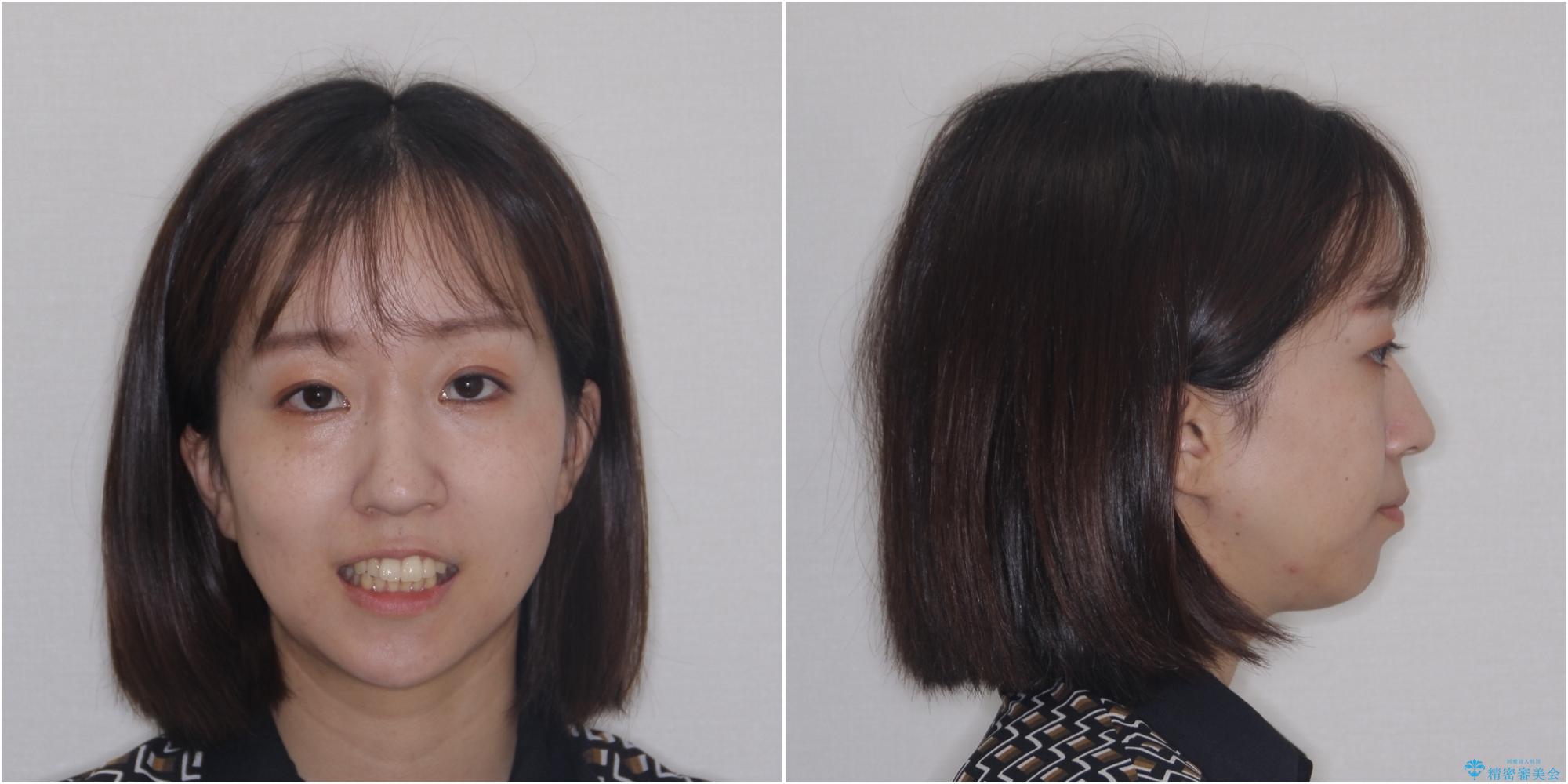 【モニター】唇が閉じにくい ワイヤー装置での抜歯矯正の治療前(顔貌)