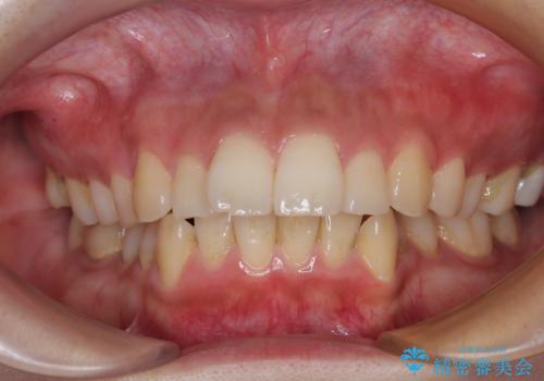 【モニター】唇が閉じにくい　ワイヤー装置での抜歯矯正の症例 治療前