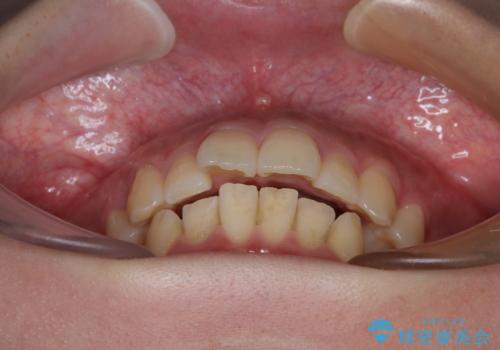 【モニター】唇が閉じにくい ワイヤー装置での抜歯矯正の治療前