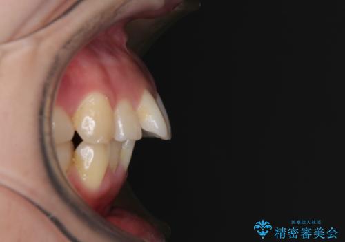 【モニター】唇が閉じにくい　ワイヤー装置での抜歯矯正の治療前