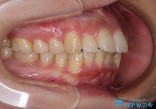 【モニター】唇が閉じにくい　ワイヤー装置での抜歯矯正の治療前